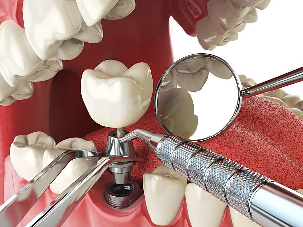 Best Emergency Dental Extractions in El Monte, CA